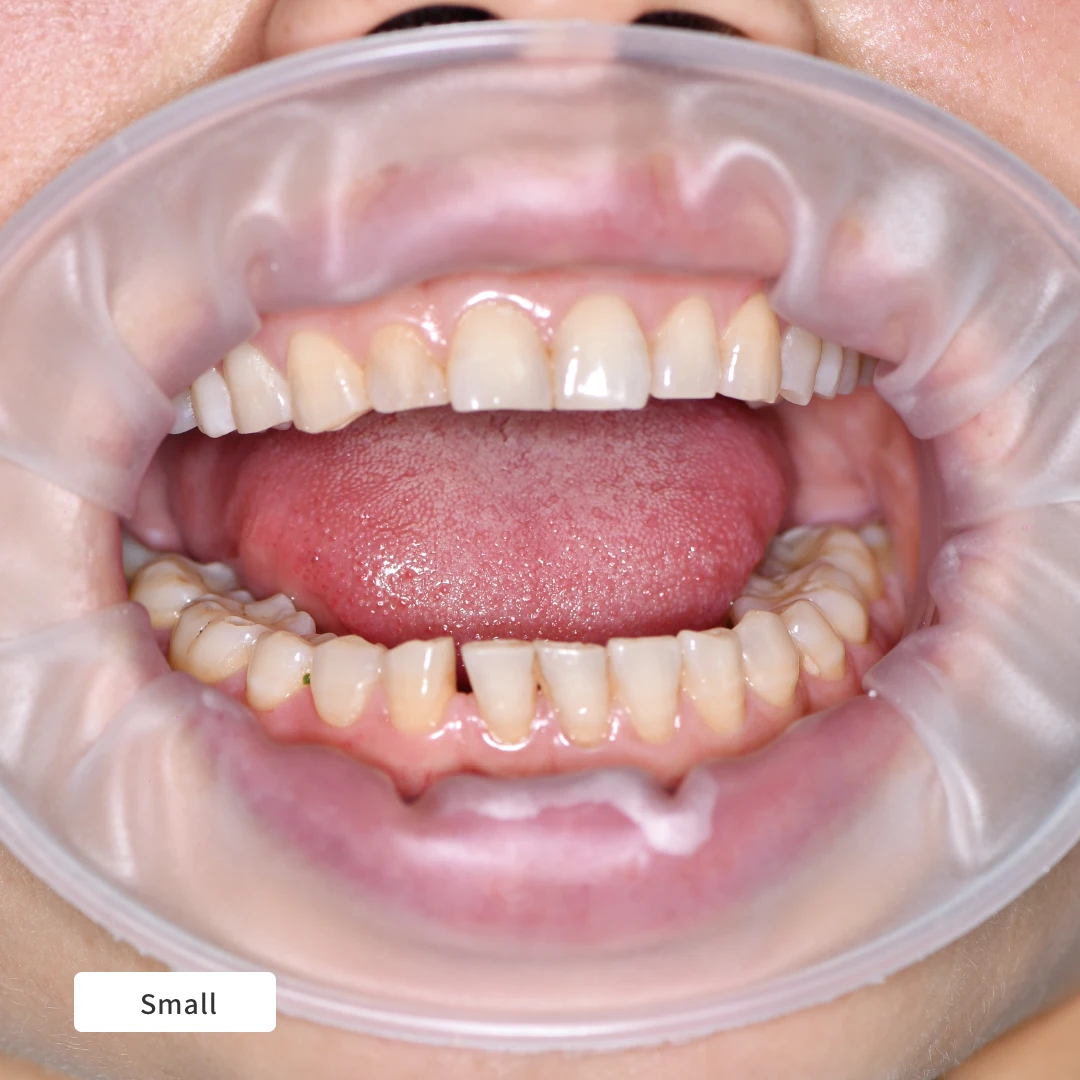 Dentpark 20 قطعة لكل صندوق ثلاثية الأبعاد على شكل حرف O خالية من اللاتكس ضام شفاه الأسنان متوسط/صغير لتقويم الأسنان وعزل استعادة