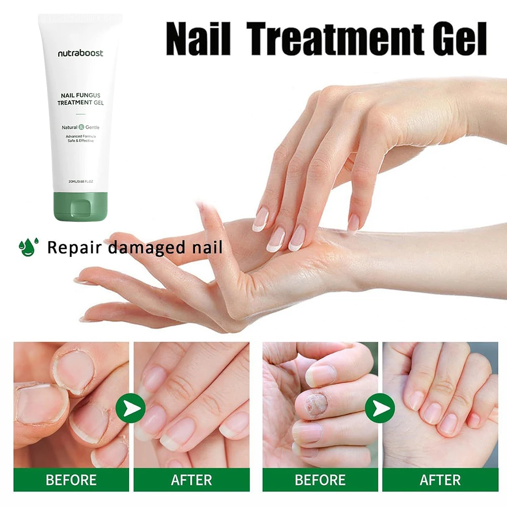 ครีมทามือไม่เหนียวเหนอะหนะบำรุงมือและเท้าเซรั่มดูแลเล็บสำหรับฤดูหนาวเนื้อเจลแห้งดูดซึมง่ายการรักษาเชื้อราที่เล็บ 20 มล