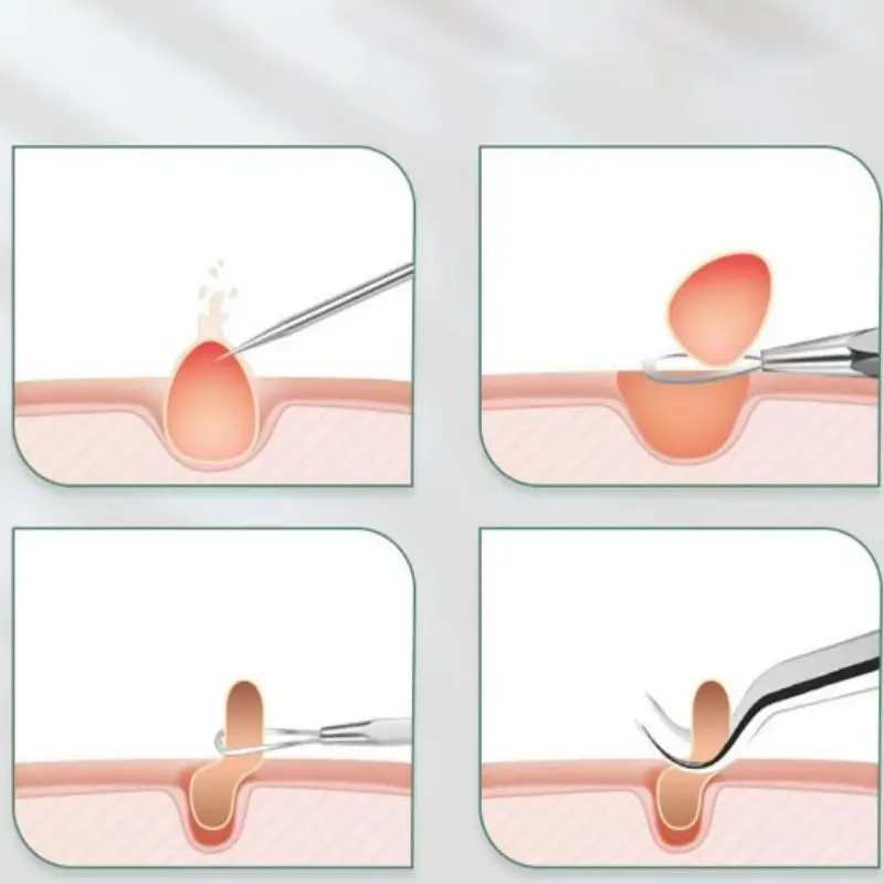 스테인레스 스틸 여드름 바늘, 얼굴 블랙헤드 제거, 여드름 바늘 족집게, 양면 여드름 바늘, 블랙헤드 미용 바늘, 5 개