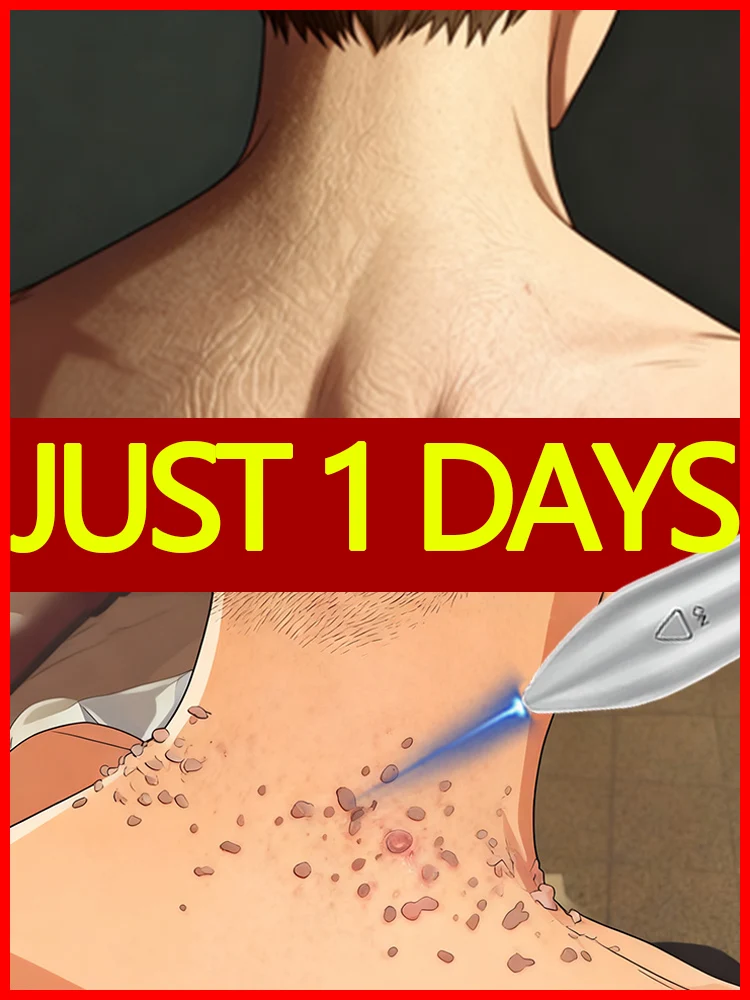 

rave reviews 10 minutes blue laser solve warts Tweezers set