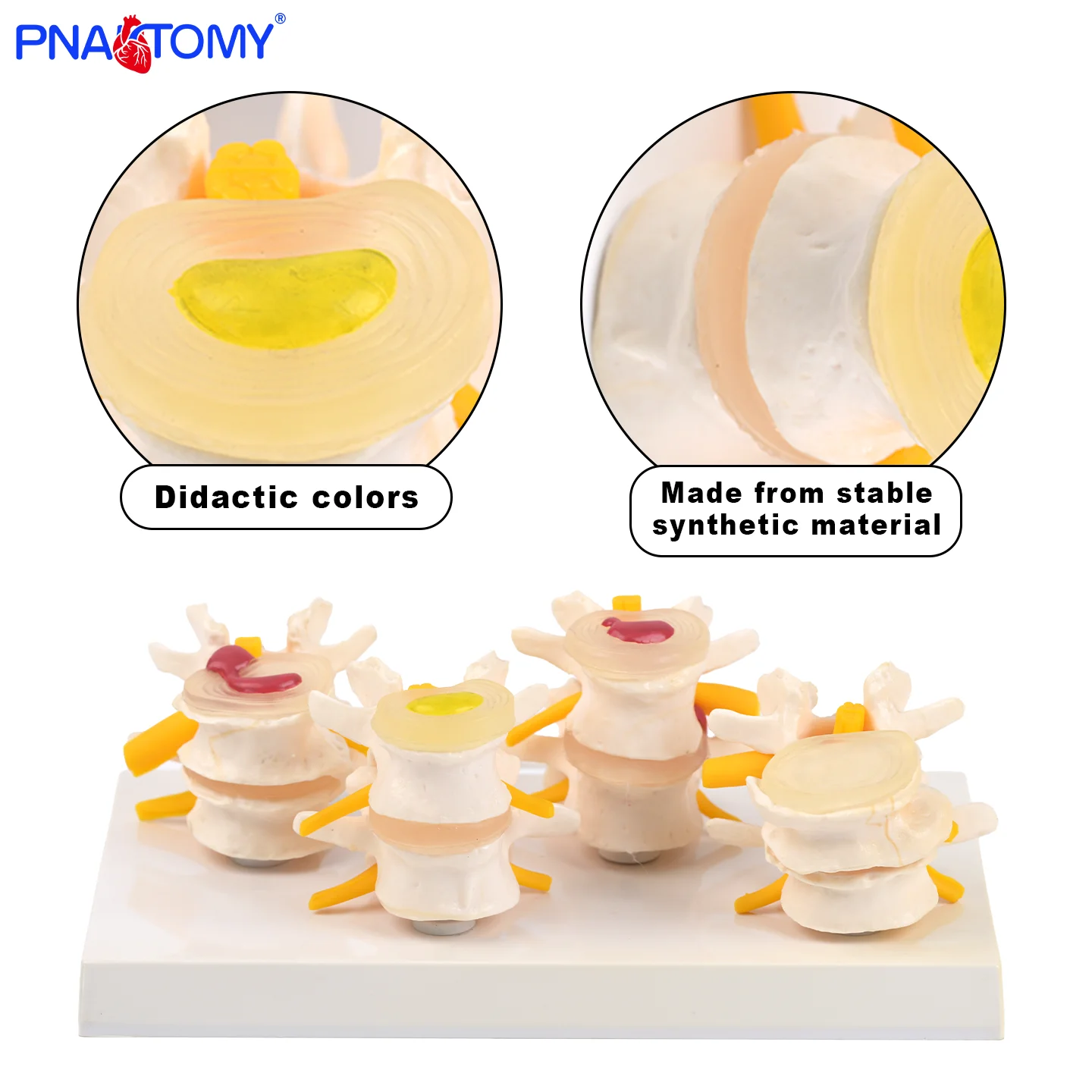

A four-stage lumbar vertebra comparison demonstration model of intervertebral disc protrusion and prolapse in orthopedics