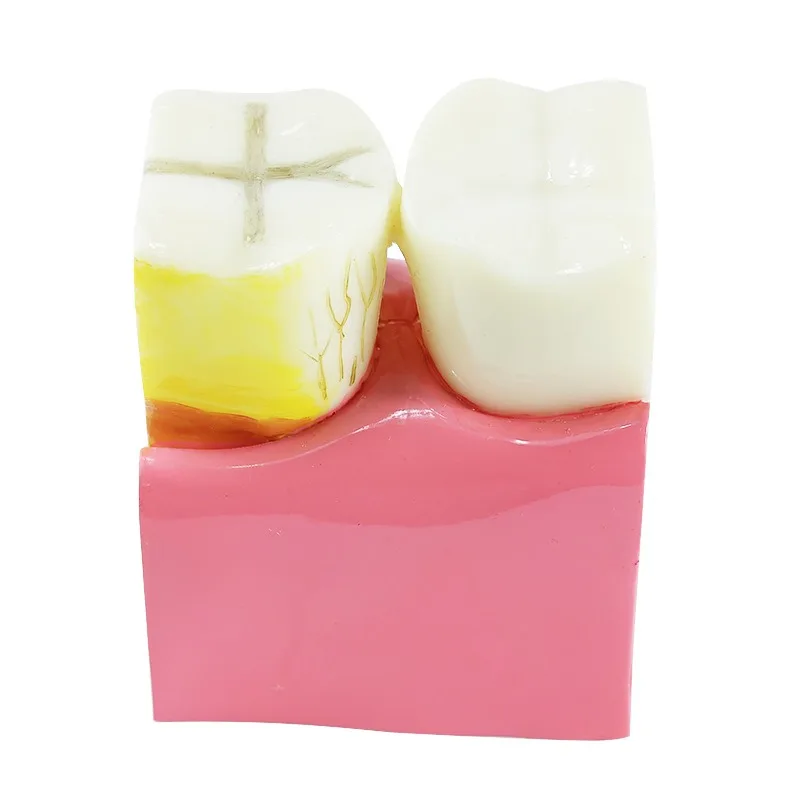 Anatomical tooth cross-section  root  nerve observation teaching comparison  dental learning  model