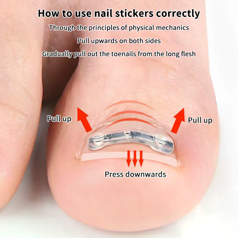 Autocollants de Correction des ongles incarnés élastiques, 2 pièces, patchs auxiliaires invisibles, traitement Paronychia, récupération
