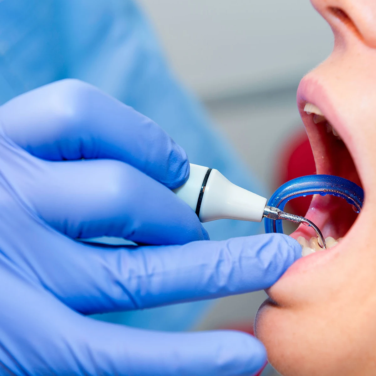AZDENT Dental Ultraschall-Piezo-Scaler-Handstück HW-3H Sterilisierter Steckgriff passend für EMS Woodpecker VRN Ultraschall-Scaler. – Detail 2