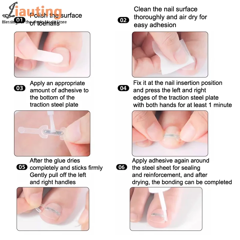 ネイルケア陥入爪矯正陥入爪治療弾性パッチステッカー矯正クリップブレースペディキュアツール