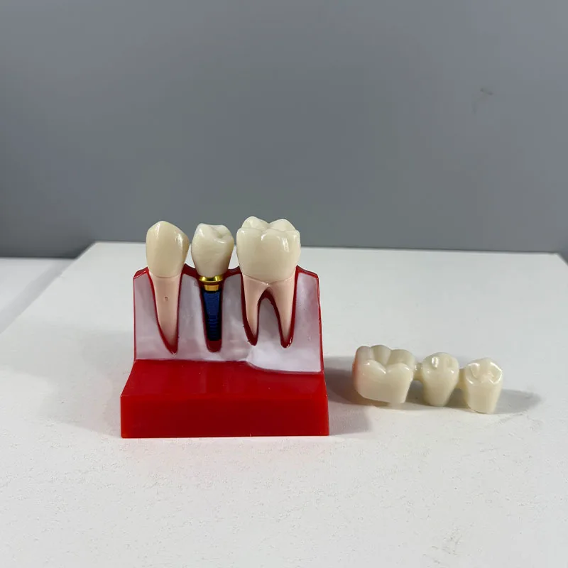 

Drop-resistant oral dentals model,crown removable implants nail display model,doctor-patient communication 4 times implants