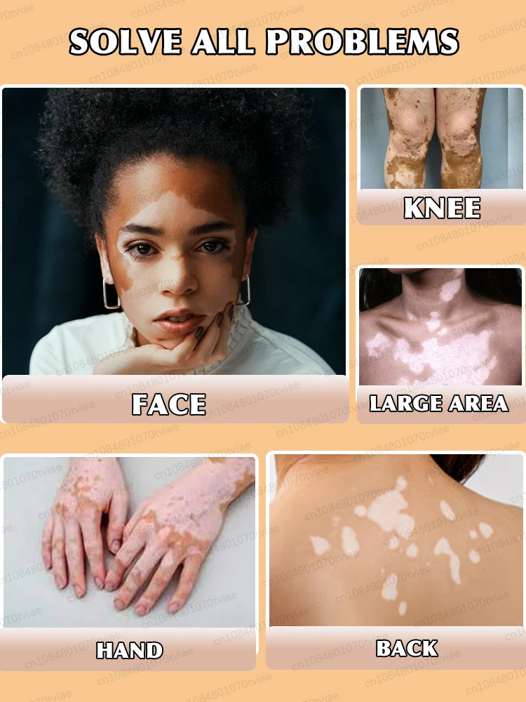 Biostimulation to treat vitiligo