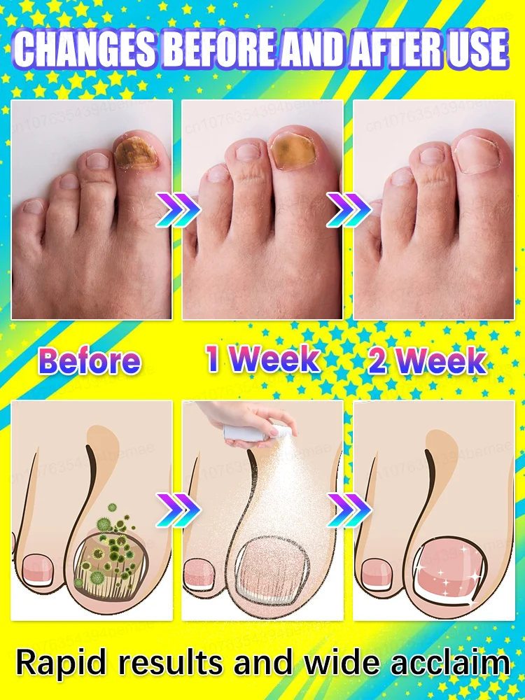 Spray per onicomicosi, facile da usare ovunque e ovunque, continua l'utilizzo e l' onicomicosi non