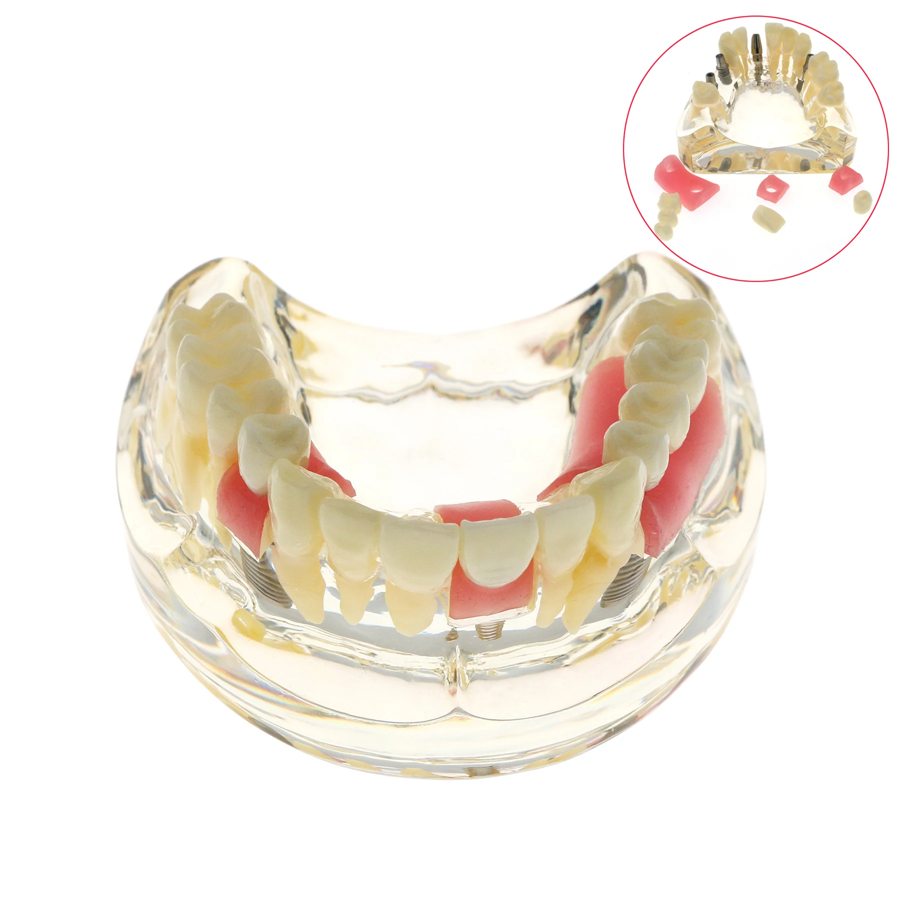 Dental Teeth Model With Implant Model Bridge And Caries Teach Study Model M2005