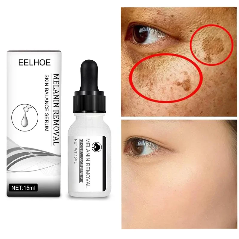 Suero de niacinamida para eliminar manchas oscuras, blanqueamiento de pecas, eliminación potente de humedad, crema para el cuidado de la piel facial, Melasma, Chloasma, puntos negros