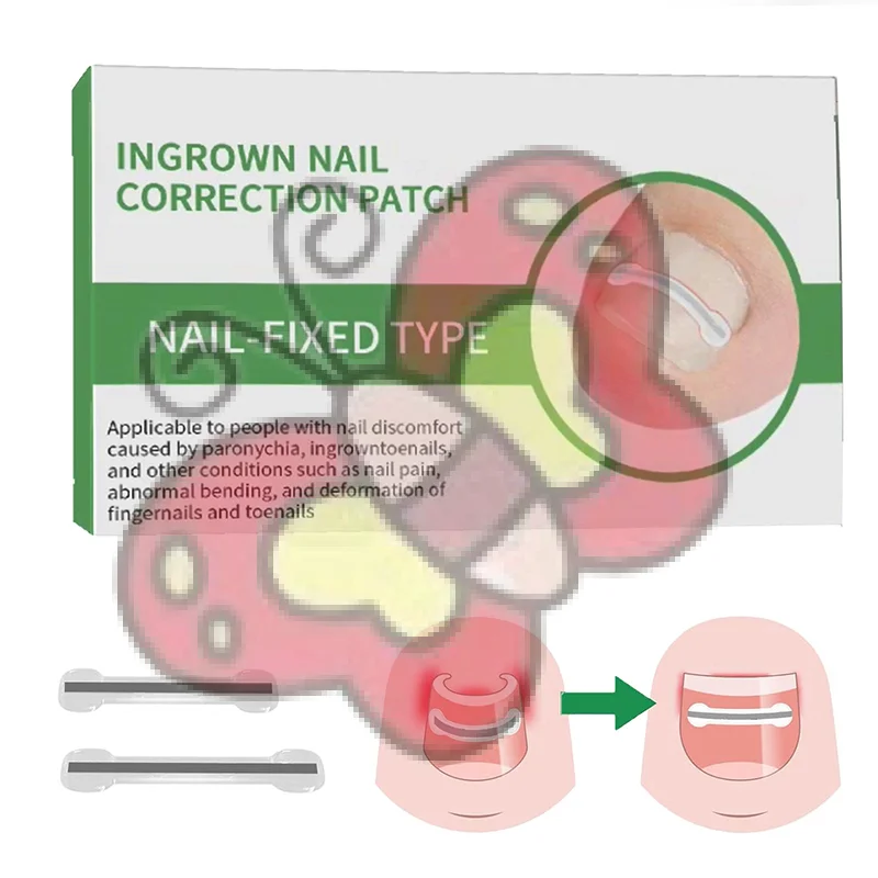 Autocollants correcteurs d'ongles incarnés, 1 pièce, patchs auxiliaires invisibles à haute résistance, traitement Paronychia