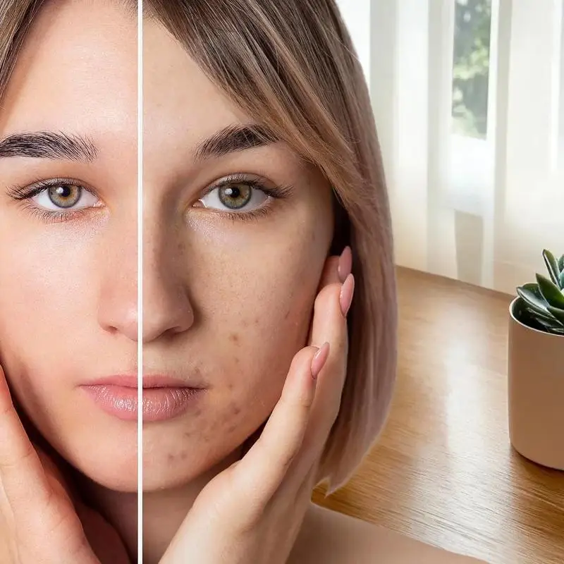 128 pièces Patchs anti-acné hydrocolloïdes à grande capacité, patchs anti-acné transparents à l'acide salicylique, patchs anti-acné invisibles, autocollants de soin de la peau