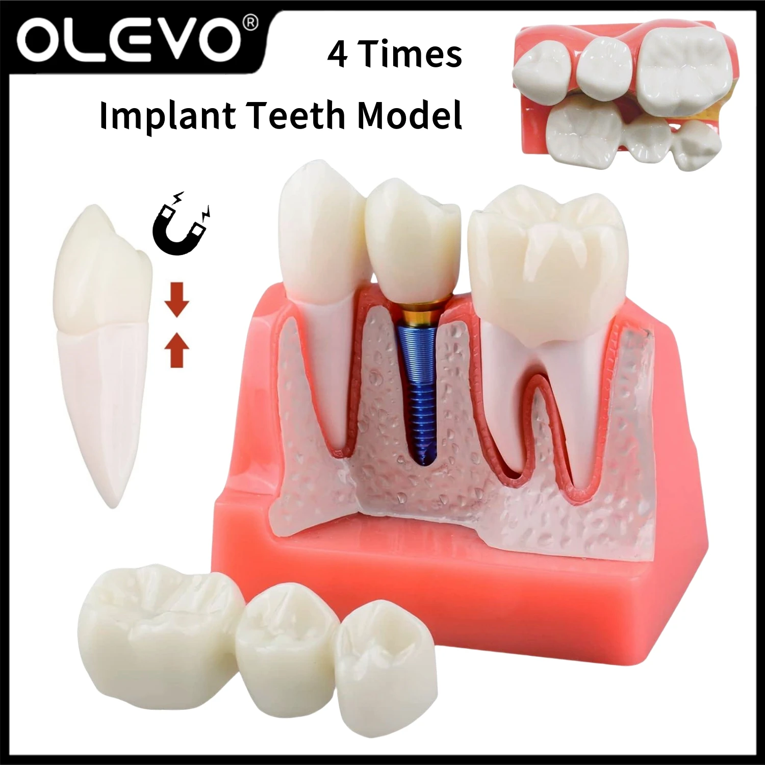 

Dental Implant Teeth Model 4 Times Analysis Crown Bridge Demonstration Removable Porcelain Teeth Model Dentistry Study Model