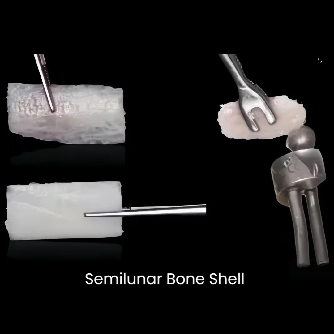 1Pcs Dental Semilunar Bone Collector Drill GBR SLT Semilunar Technique Semilunar Shell Bone Argumentation Easy Bone Colloector