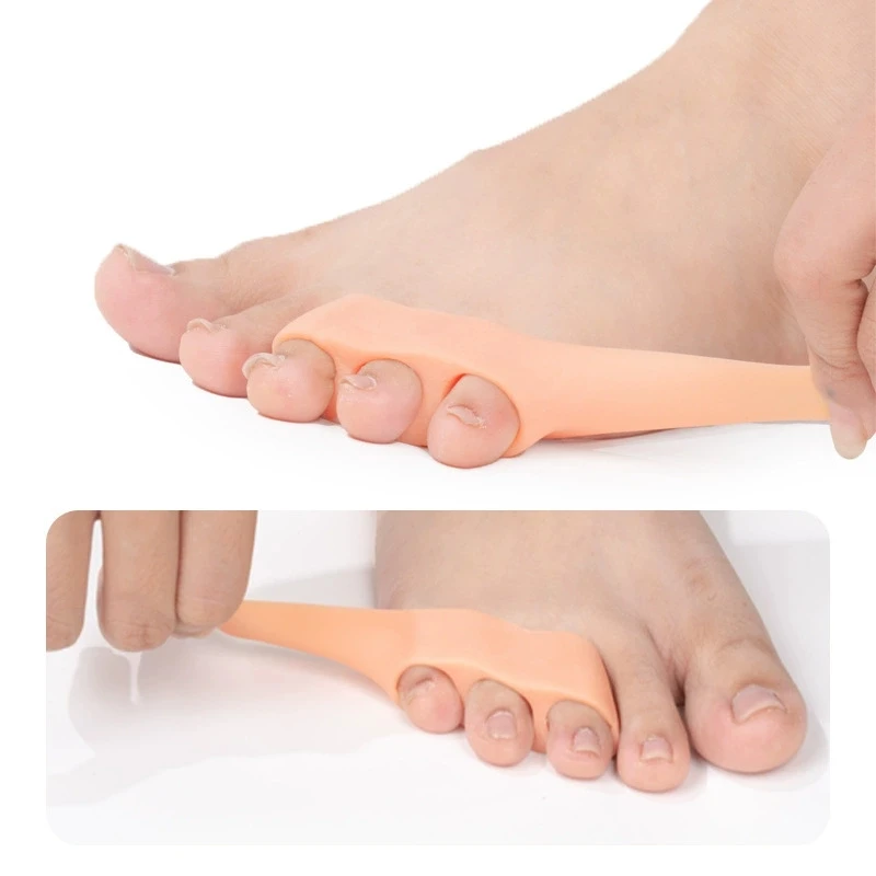 

Корректор для пальцев ног от вальгусной деформации (1/2/5/10 пар): ортопедические корректоры для пальцев, выпрямители для косточек на ногах, средство для ухода за стопами