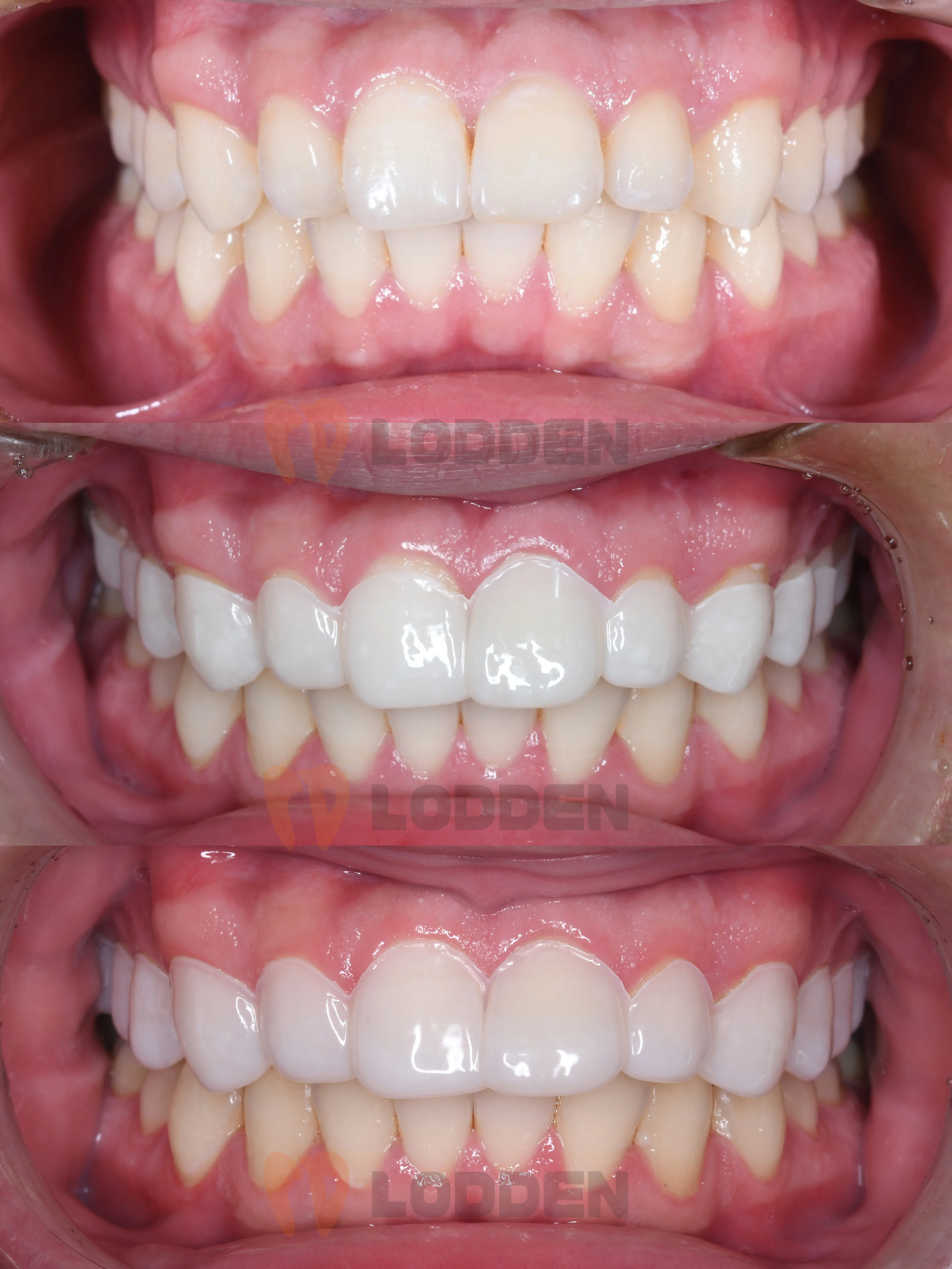 10pcs/bag Dental Veneer Sheet Film Snap A1/A2/OM1 Color Square/Round Cosmetic Veneer Sheet Film for Retainers Braces