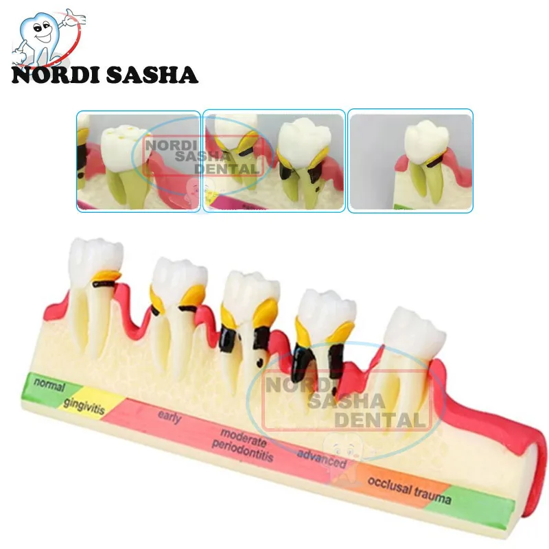 Big Brand Dental Periodontal Disease Model Dentistry Periodontal Disease Classification Demonstration Model Oral Teaching Model