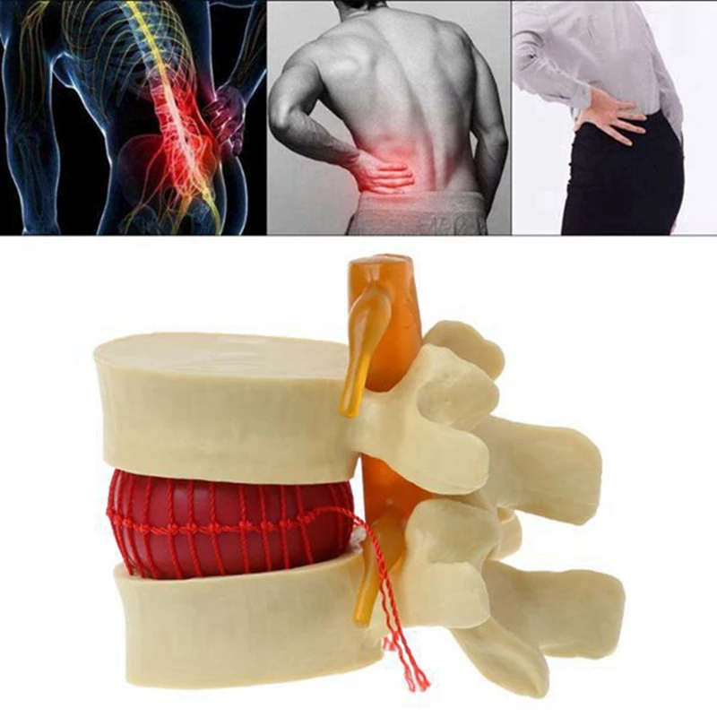 2X Lumbar Vertebrae Model Anatomical Spine Lumbar Disc Herniation Anatomy Teaching Tool Lumbar Vertebrae Model