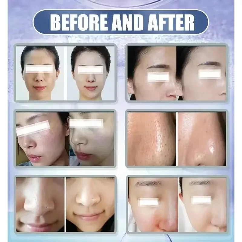 フェイシャルマネジメントM6ハイドラダーマブレーションマシンディープクレンジングホワイトニングアクアダーマブレーションブラックヘッド除去美容機器