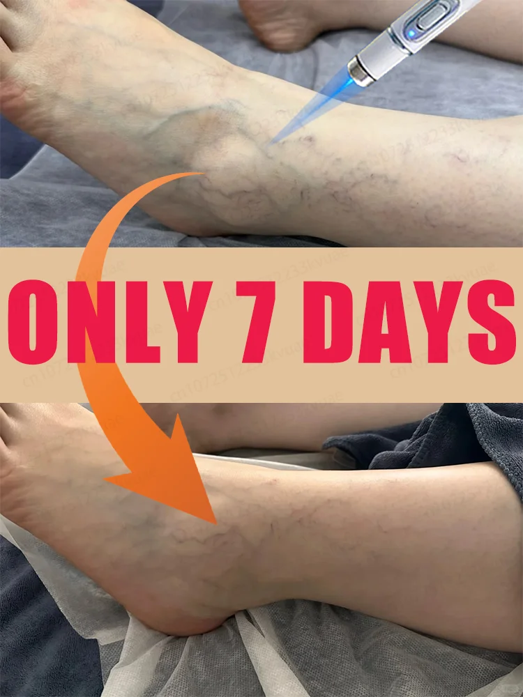 

blue light pen solve varicose veins, hot sale leg care tools