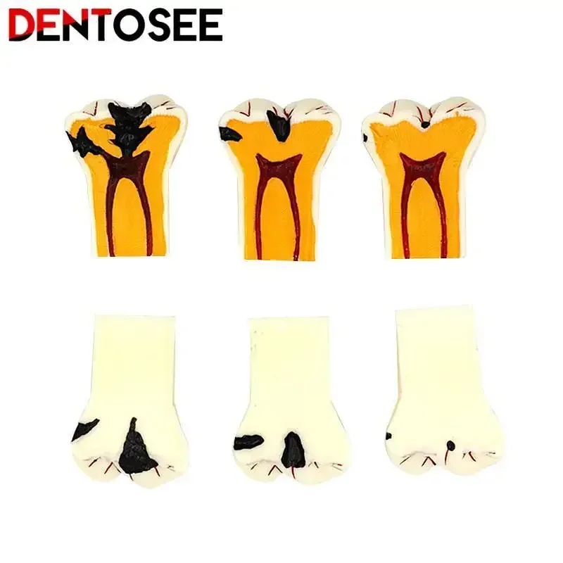 

Зубной протез, кариес, болезнь, модель зуба, разложение, кариес, модель зуба, инструменты для обучения зубами