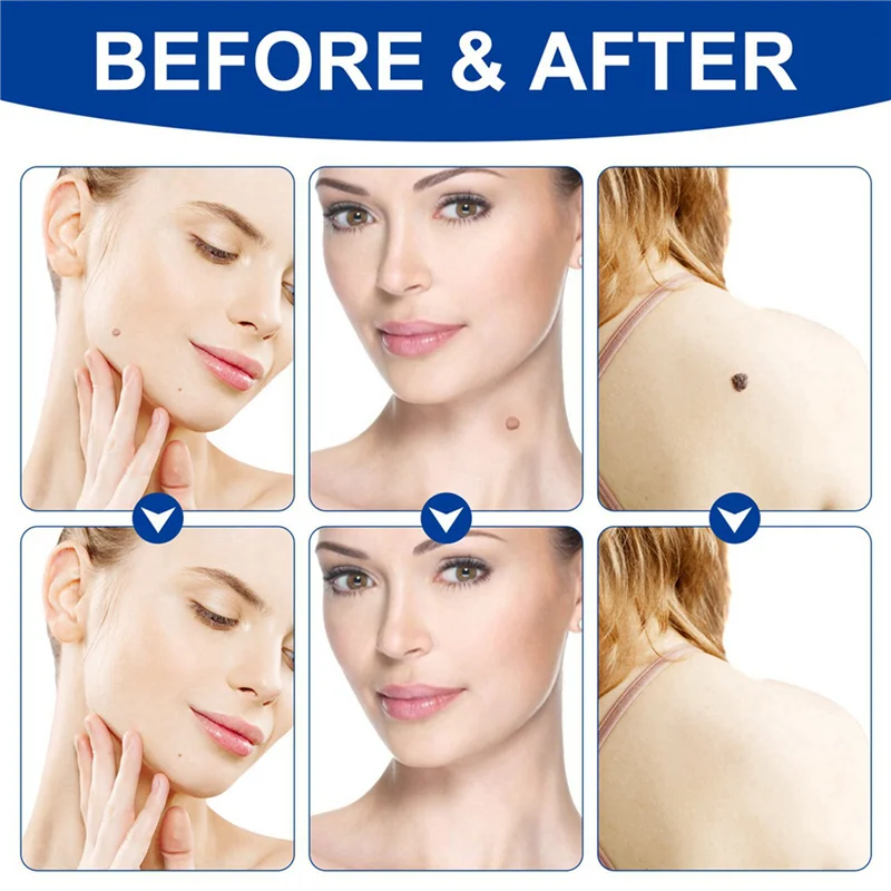 N95R 2X Kit de retrait d'étiquettes de peau stylo d'élimination d'étiquettes de peau indolore dispositif d'élimination d'étiquettes de peau facile élimine les étiquettes de peau de 4Mm-9Mm