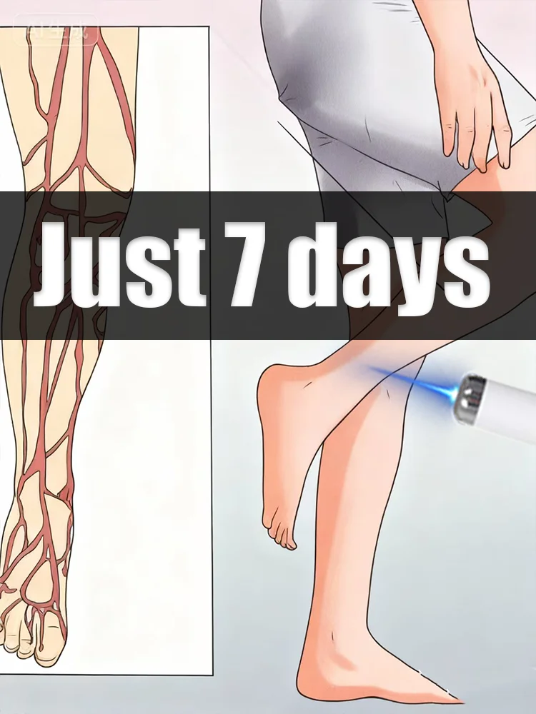Blue laser pen for treating abnormal veins in the legs