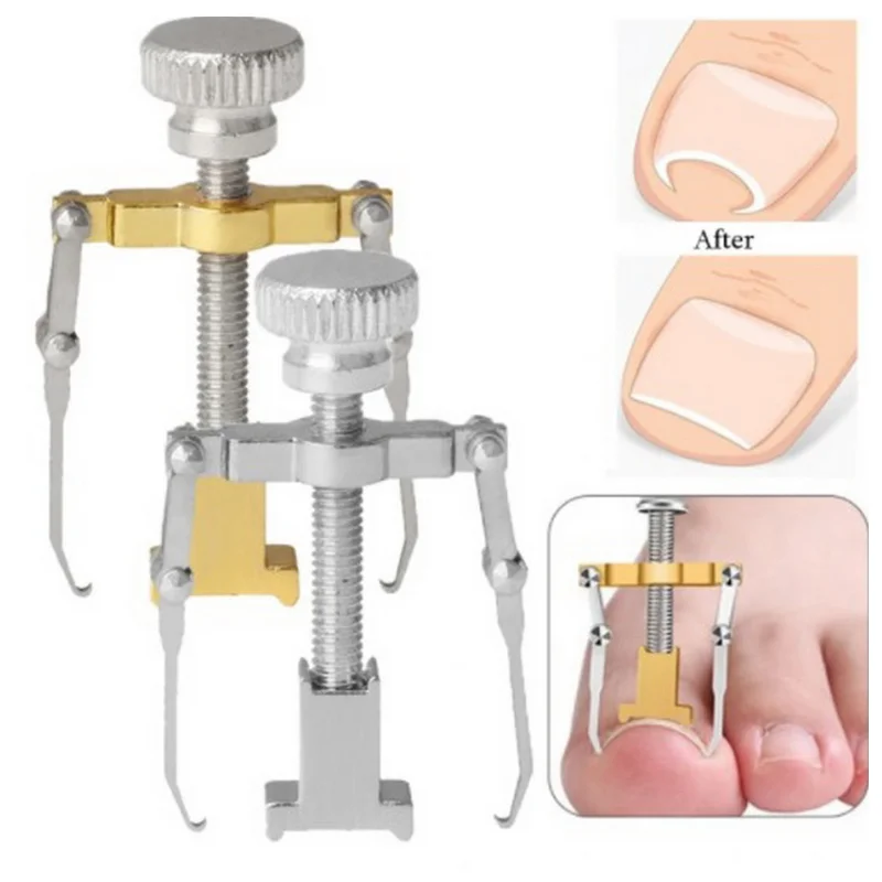 Corretor de unha encravada, clipe de alisamento, levantador de unha, paroníquia, remendo para pés, tratamento de pedicure, ferramenta de cuidados com os pés