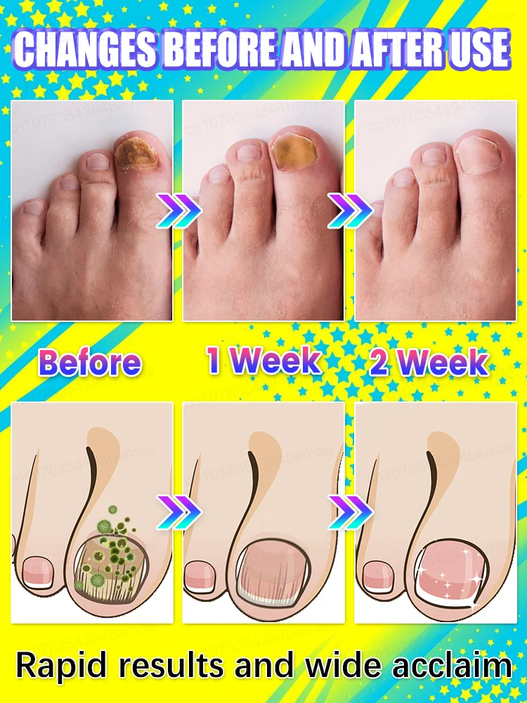 ᴰᵒⁿ’ᵗ ˡᵉᵗ ᵒⁿʸᶜʰᵒᵐʸᶜᵒˢⁱˢ turn into rotten nails! Intervene early