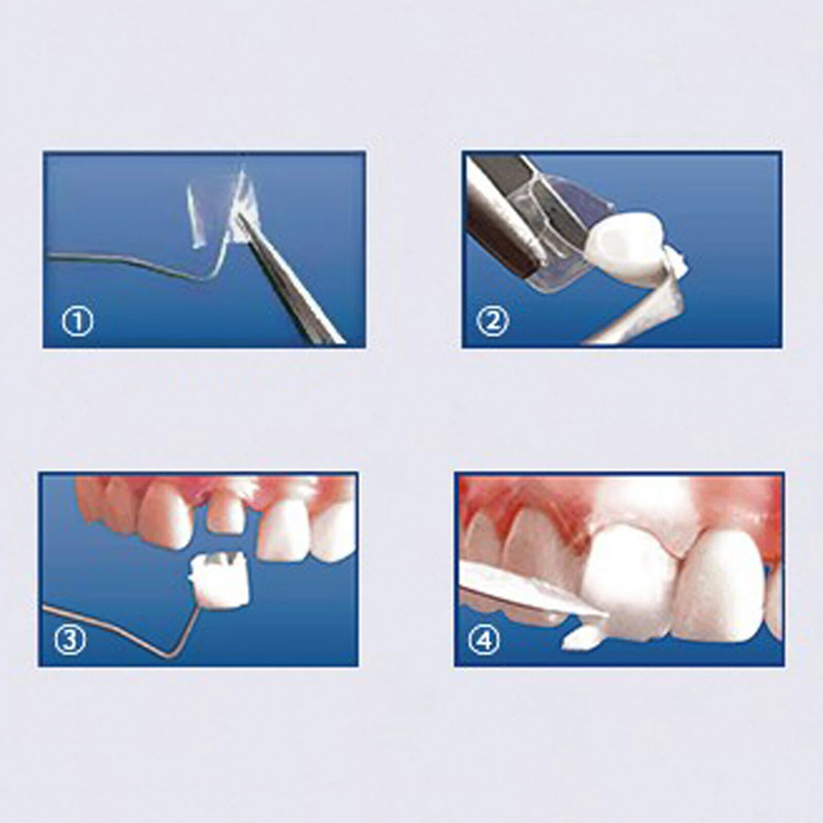 Dental Anterior Transparent Forms For Temporary Crowns 1.910 Kit 64Pcs/Box