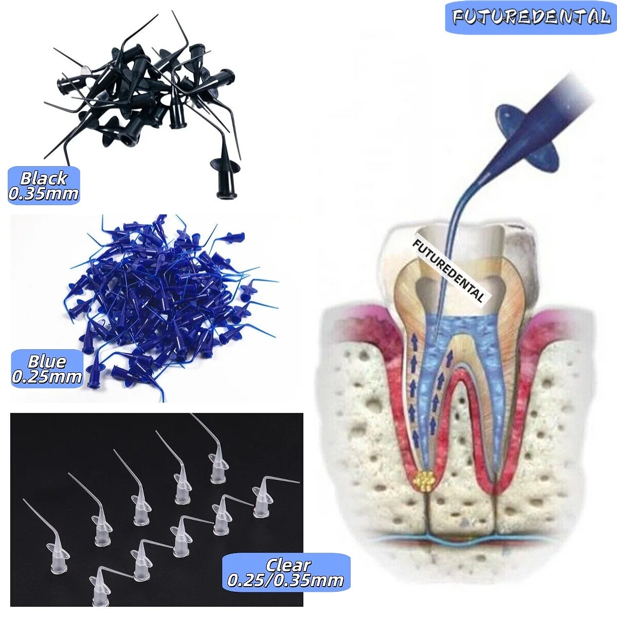 100 embouts d'irrigation dentaire jetables, embout d'irrigation pour canal radiculaire, embout en plastique, diamètre fin, conduit flexible, noir, bleu, transparent