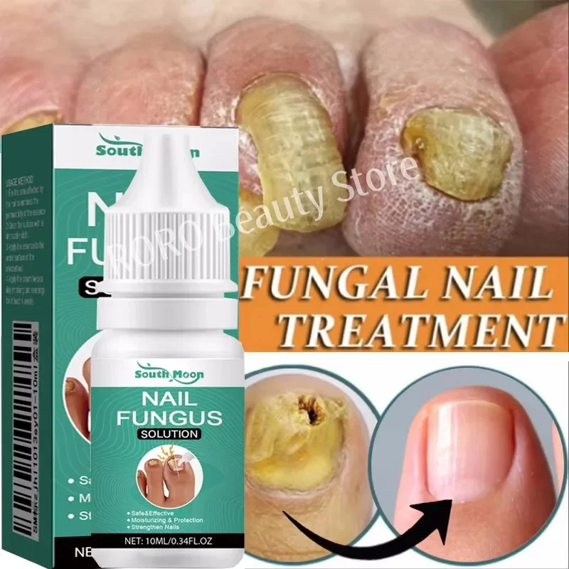 7 giorni Trattamento Fungine Delle Unghie Siero Piede Rimozione Fungo Delle Unghie Gel di Riparazione Anti Infezione Paronichia Onicomicosi Unghie Del Piede Cura