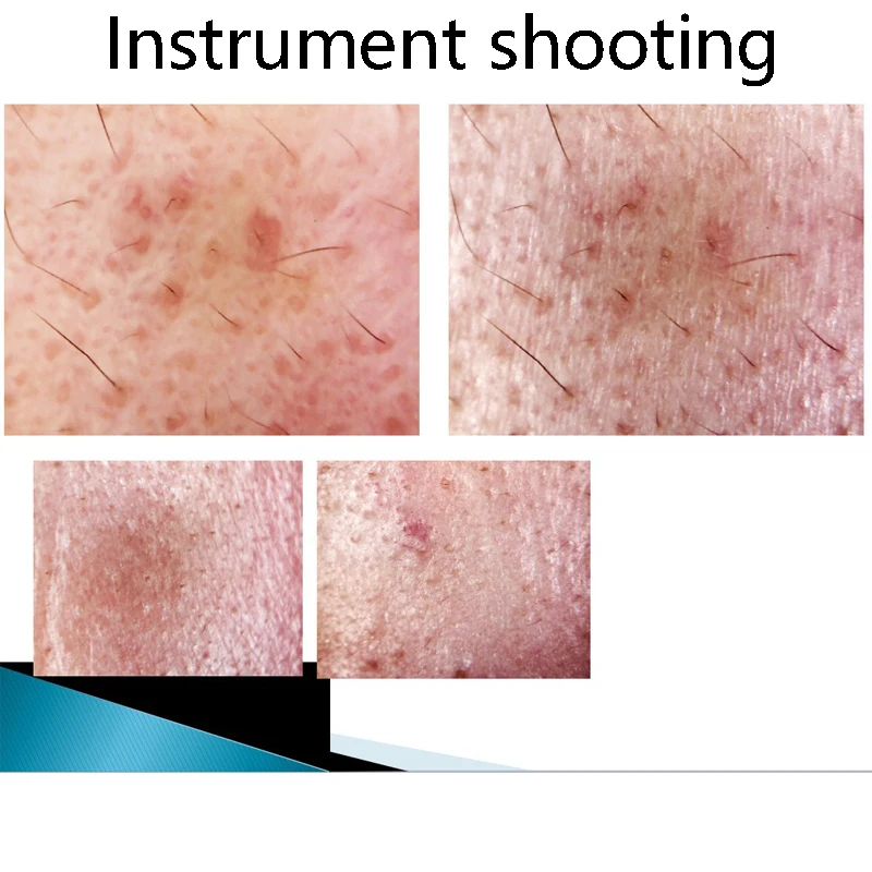 Intelligente huidanalysator Vochtanalysatie Oliegehalte Tester