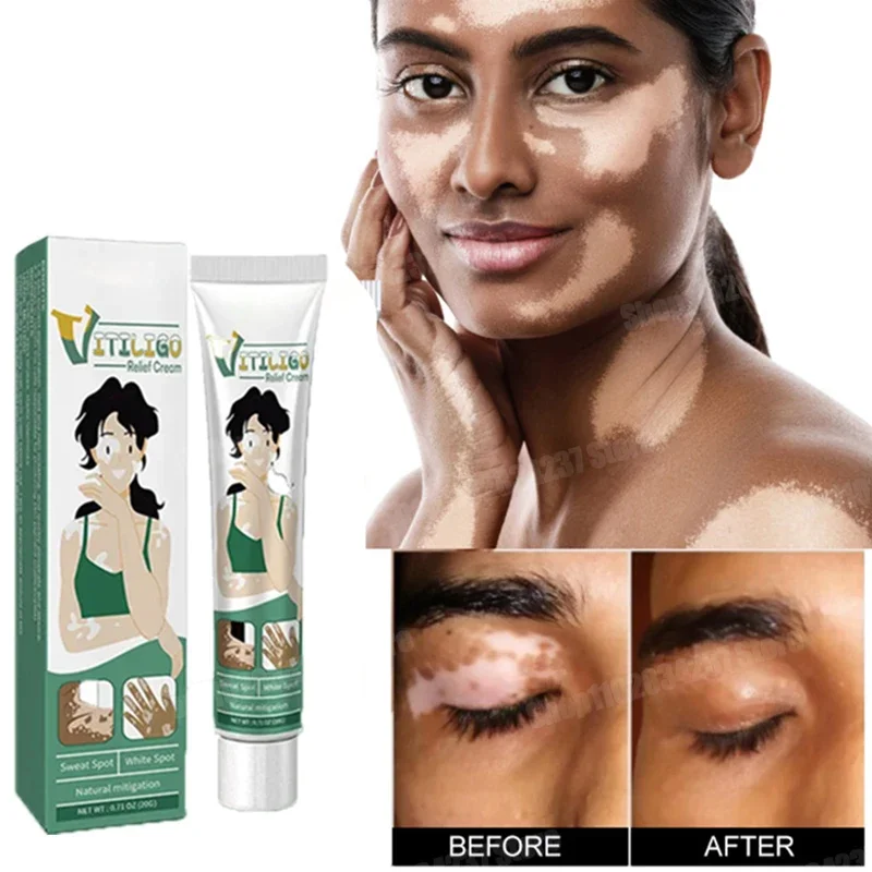 Vitiligo Safe Repair Brightening Lasting Increase Confidence Improve Skin Appearance Natural Ingredients 1