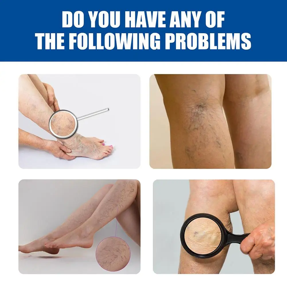 Salbe gegen Krampfadern. Effektive Creme zur Linderung von Krampfadern zur Linderung von Bein-Vaskulitis, Venenentzündung, Spinnenschmerzen, Pflege