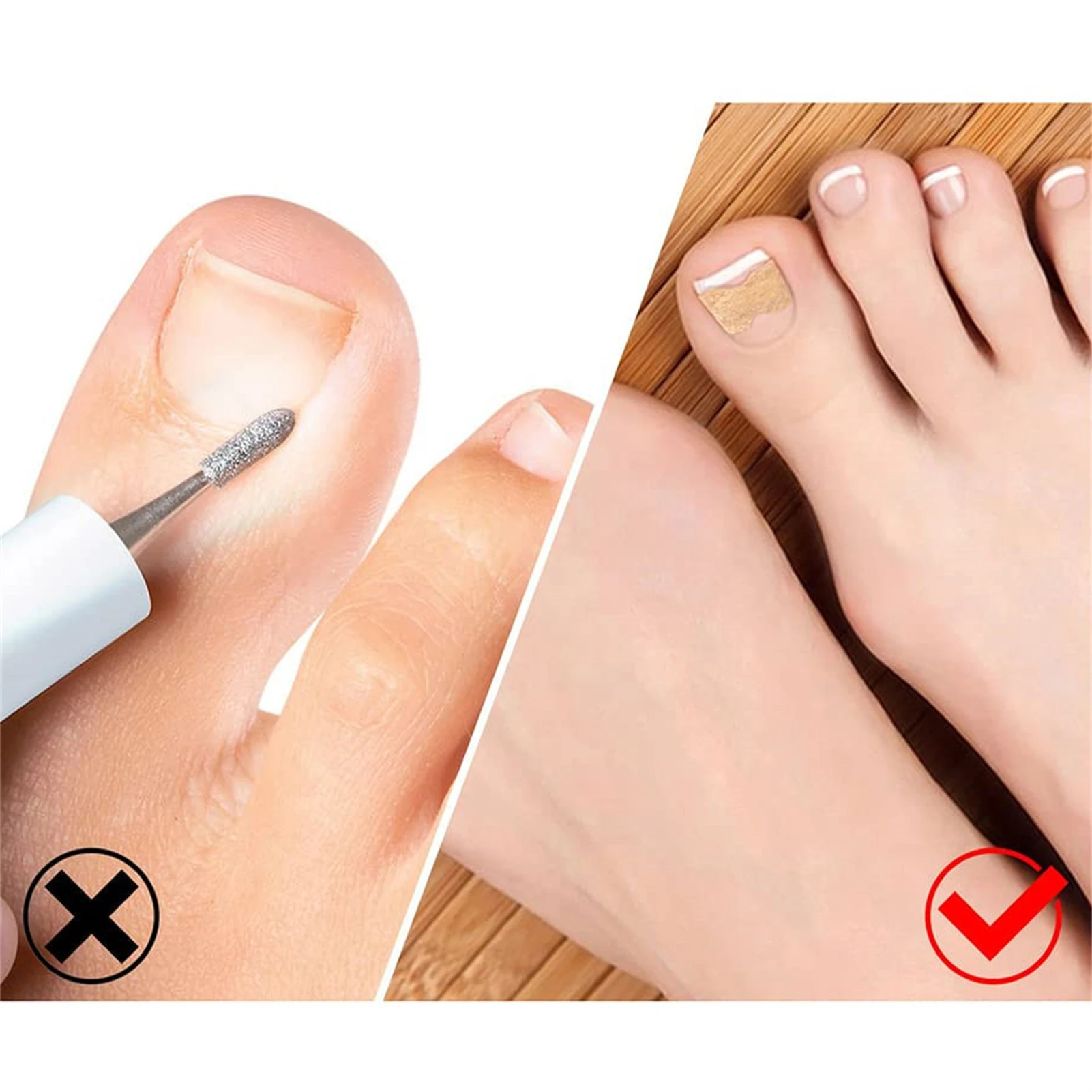 16 stücke Nagel Korrektur Aufkleber Wasserdicht Eingewachsene Zehennagel Korrektur Streifen Anti Infektion Nagel Behandlung Patch Gesundheit Zehen Pflege