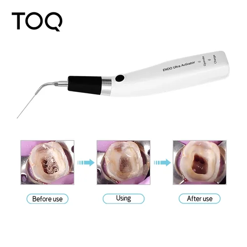 Activador ultrasónico inalámbrico Endo Ultra activador Dental con 6 puntas 40-50Khz 1500mAh para tratamiento endodóntico