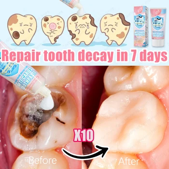 إعادة شراء 99% من الناس، حار بيع إصلاح تسوس الأسنان