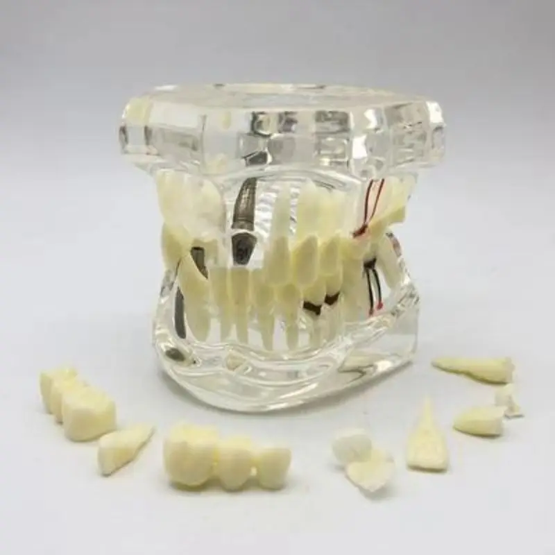 Dental teeth Adult pathology model Doctor-patient communication The demo model Dental caries free shipping