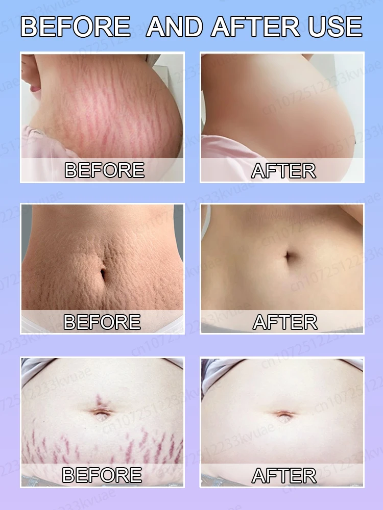 Entfernen Sie Dehnungsstreifen, berechnen Sie Streifen vor, beseitigen Sie sich, beseitigen Sie keine Narben in nur 7 Tagen