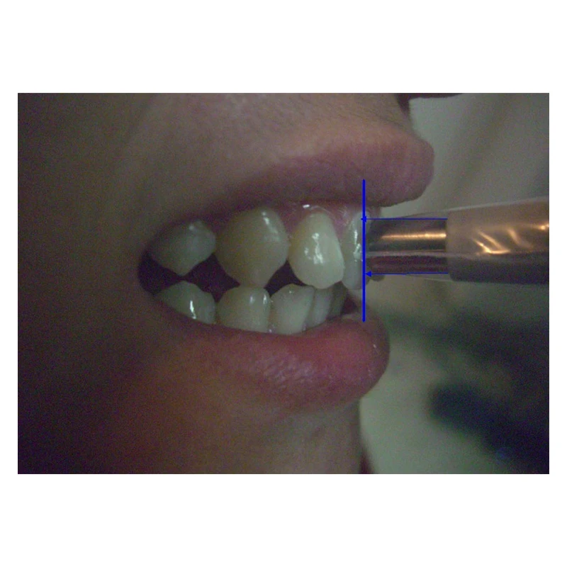 

Dental Teeth Whitening Digital Shade Guide LED Tooth Color Comparator