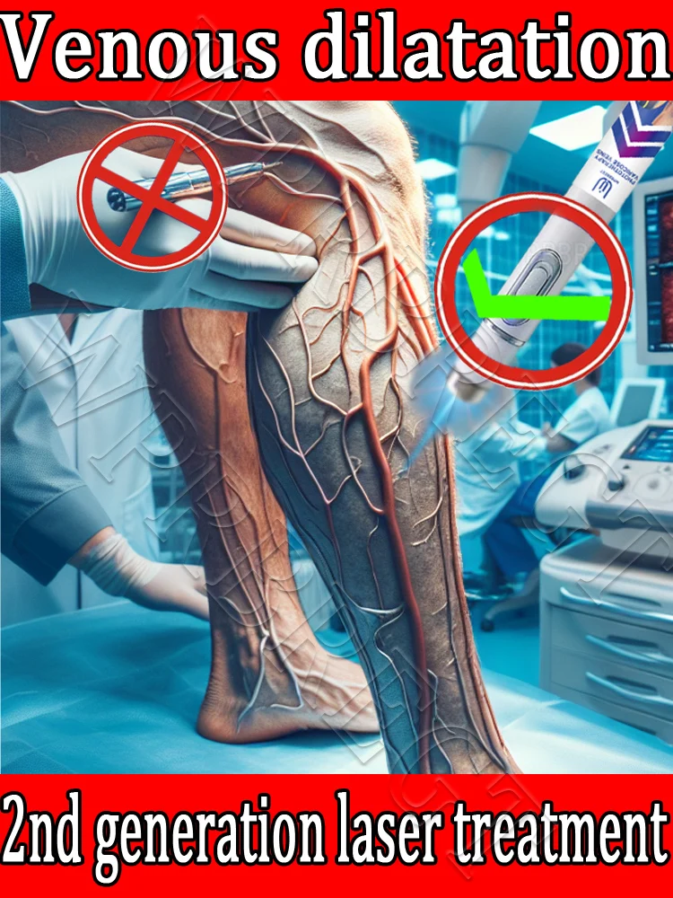 

Удаление варикозного расширения вен из тела.