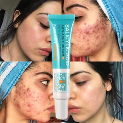 Ácido salicílico Acne Tratamento Creme, Repair Pimple Spots, Limpeza profunda, Poros encolhendo, Anti-acne Oil Control Hidratante, Cuidados com a pele