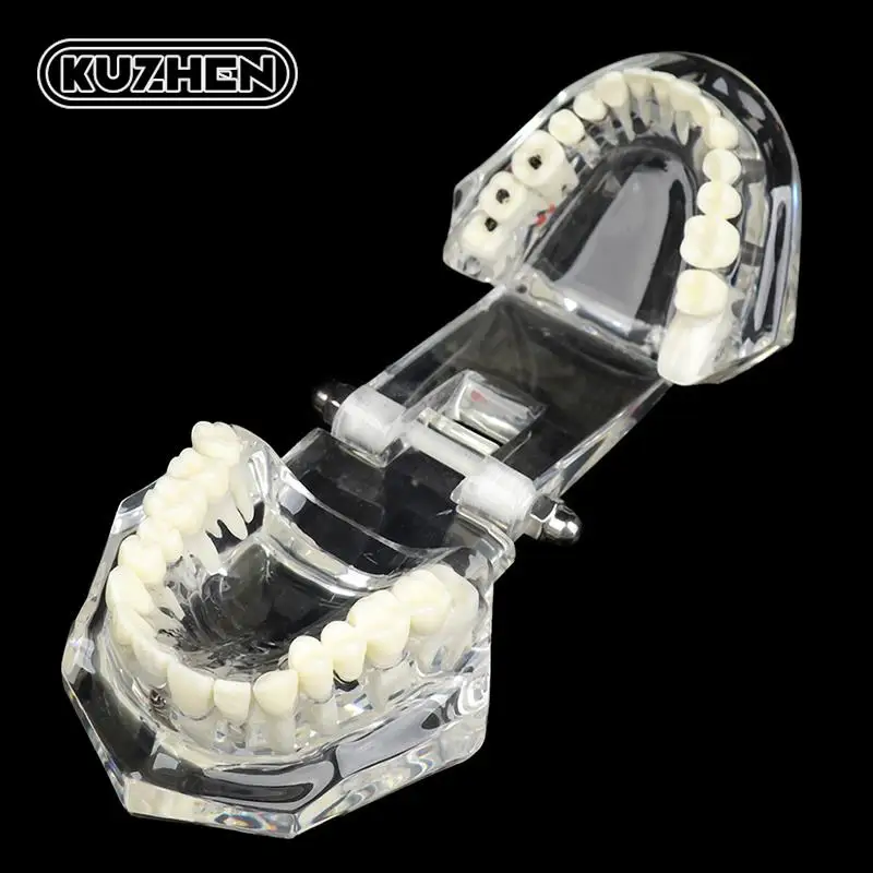 Dental Model Teeth Implant Restoration Bridge Teaching for Study Tooth Science