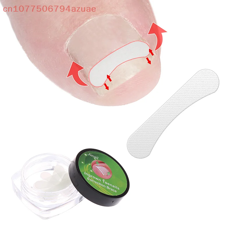 10Pcs Eingewachsene Zehennagel Korrektur Werkzeug Richt Clip Klammer Eingewachsene Zehennagel Behandlung Elastische Patch Aufkleber Pediküre Werkzeug