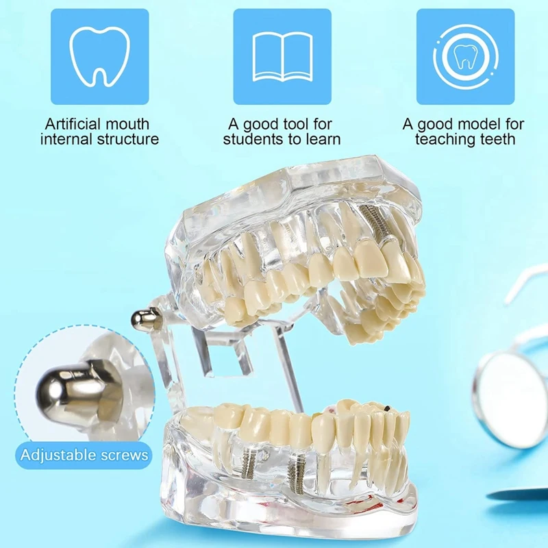 Modelo do implante do typodonts com dentes removíveis, demonstração padrão do dente do dentista