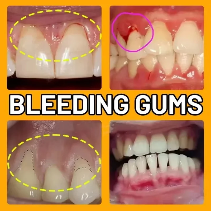 Gum Relief Drop Effective Repair Damaged Gums Relieve Toothache Strengthen Teeth And Gums Remove Yellow Plaque Stains Gum Care