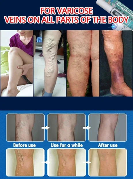 Varicose vein laser pointer | Improves Blood Circulation | Blue Light Laser