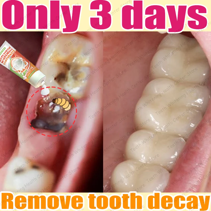 Risolvi problemi di carie dei denti e mantengono i denti sani