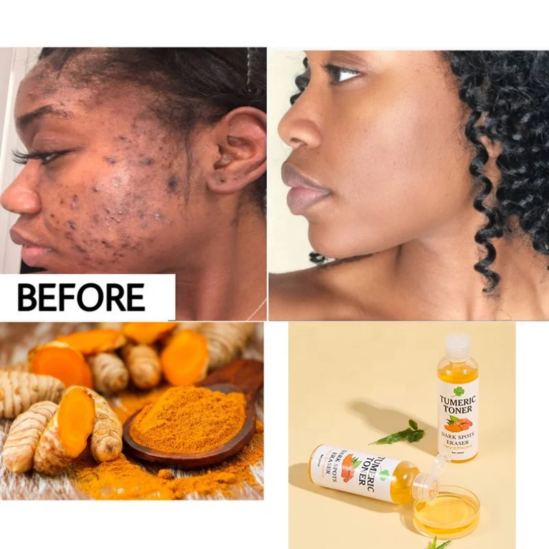 

100ml Tumeric Dark Spots Toner Spots Eraser Corrector Turmeric Fades Blemishes Dark Spots Acne Remover Toner